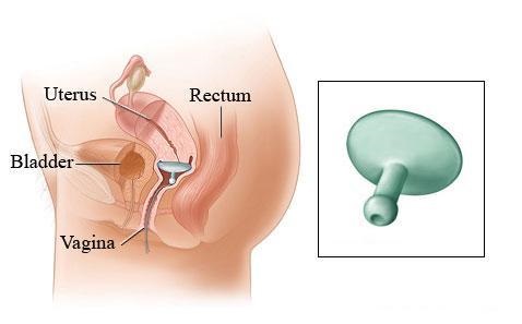 Dispositivos Gellhorn De Dr ARABIN. Pacientes con prolapso grave de la vagina.