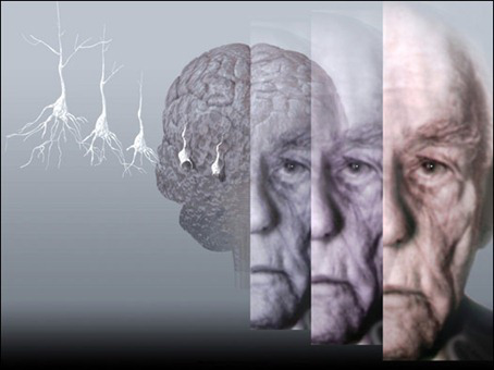 Alzheimer: La Distorsión del Tiempo 