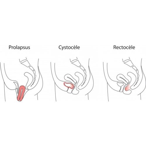 Diopositivo Para Preolapso GIN & CUBE. Tratamiento del prolapso de las paredes vaginales y el útero.